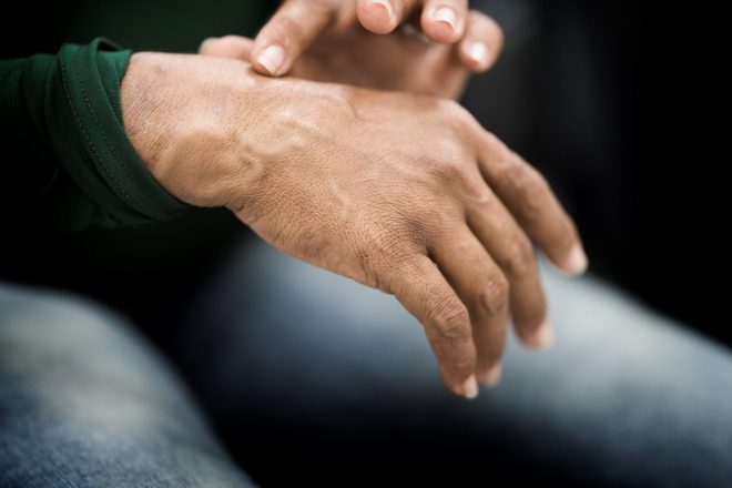 Josiane haar handen zijn bezaaid met vlekken